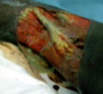 Buruli ulcer — arm, Issouf