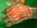 Buruli ulcer — hand, Hélène