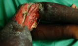 Buruli ulcer — limb, Jonathan