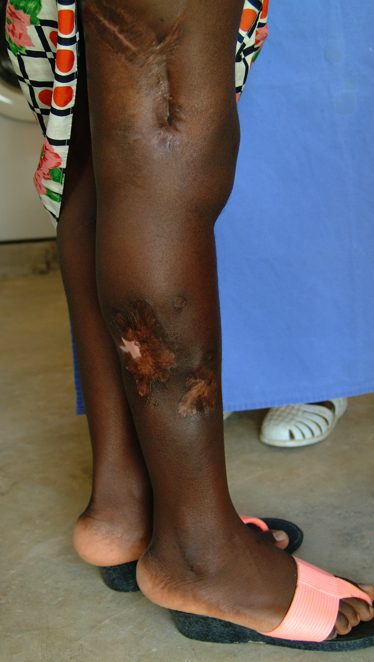 Day 42: Ella jambe dr. 1 mai